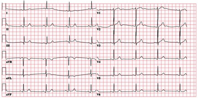 ECG-Question-9-bradycardia-oHzWtX7bxt.jpg