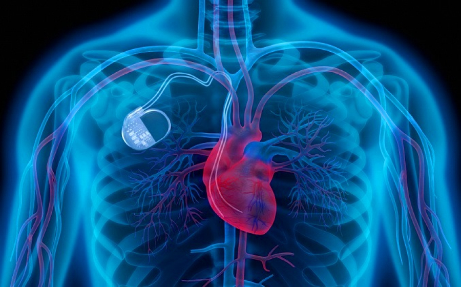 Almaty surgeons perform implantation of subcutaneous cardioverter-defibrillator