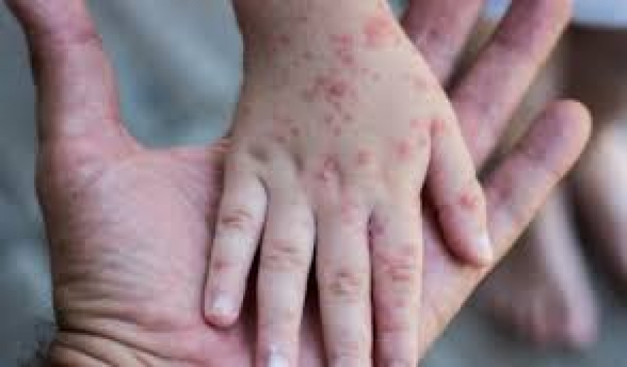 Kazakhstan registers no cases of monkeypox infection, Health Ministry says